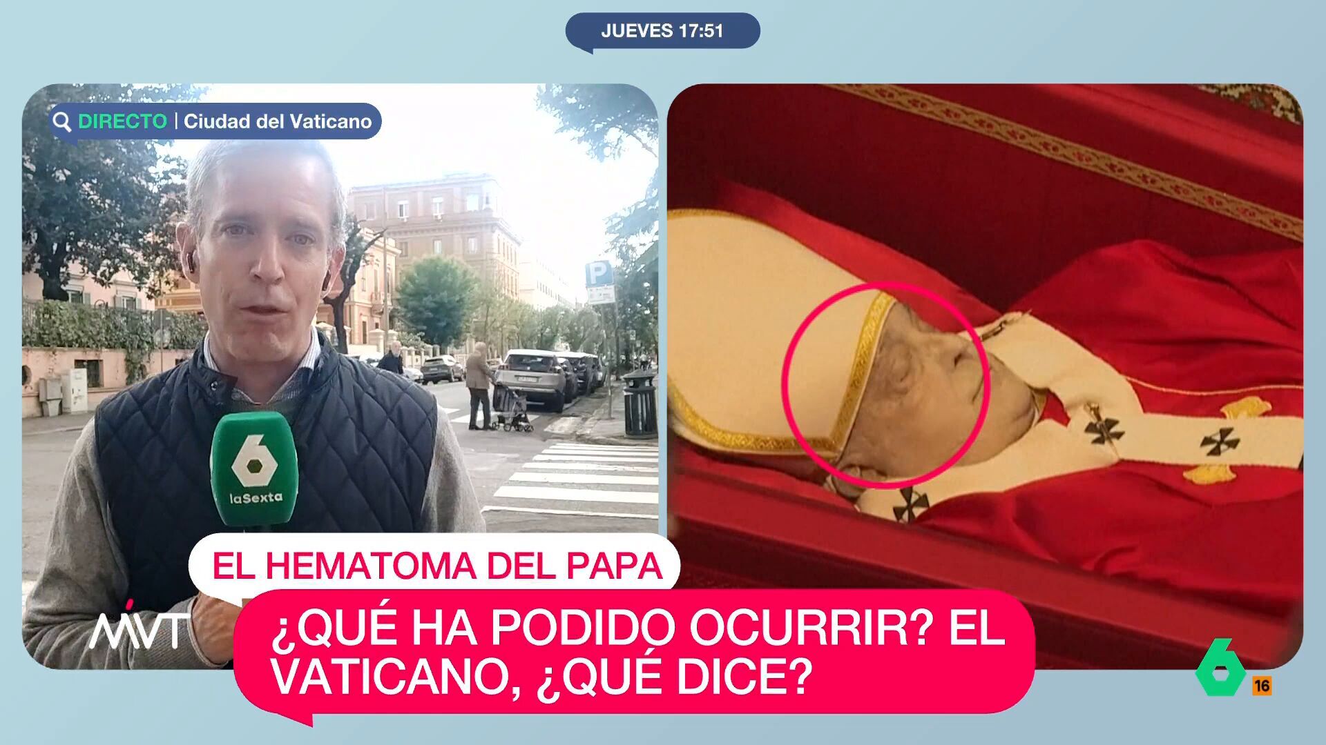 Abril 2025 (24-04-25) Misterio resuelto: el Vaticano explica por qué el papa Francisco presenta un enorme moratón en la cabeza