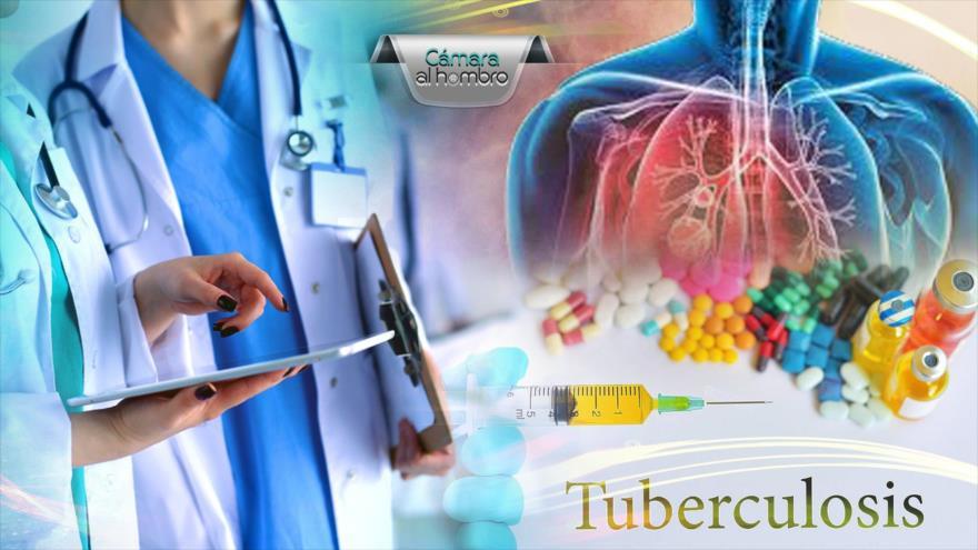 La tuberculosis: un drama para más de 30 000 peruanos
