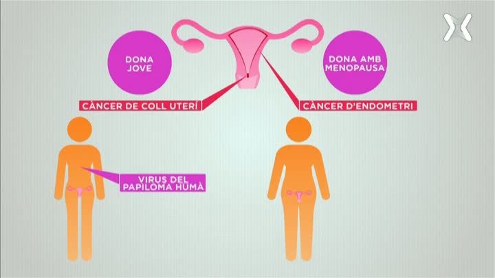 El càncer en clau femenina